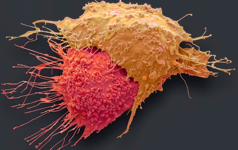 We Must Find Ways to Detect Cancer Much Earlier - NewsOpener We Must Find Ways to Detect Cancer Much Earlier