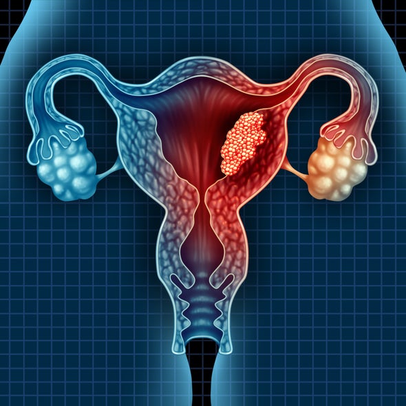 طريقة جديدة أسرع وأدق وأقل كلفة لاكتشاف سرطان عنق الرحم للع لم