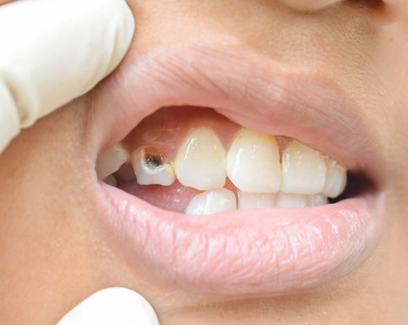 ما الدور الذي تلعبه البكتيريا في نخر الأسنان ؟؟