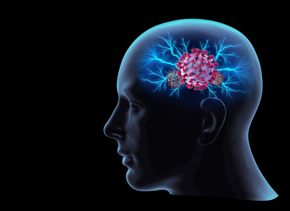 كوفيد-19 يؤدي إلى حدوث تشوهات في أنسجة المخ