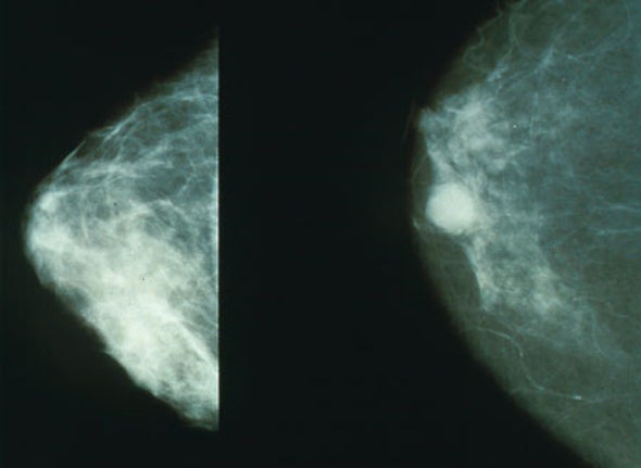 Questioning Mammograms Versus "Torturing the Data"