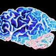 We Need New Biomarkers for Alzheimer's Disease