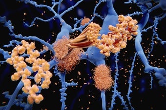 Could Alzheimer's Be a Reaction to Infection?