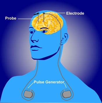 deep brain stimulator deep brain stimulator