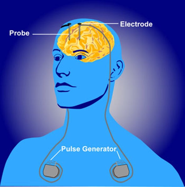 Much-touted Deep-Brain-Stimulation Treatment for Depression Fails Another Trial