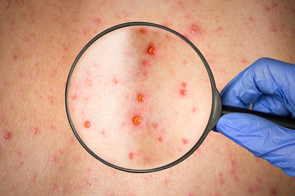 Anti-Vaxxers Are Here to Stay