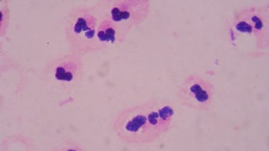 The Scourge of Sepsis