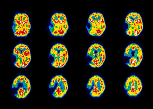 We've Made Astonishing Progress in Treating Stroke