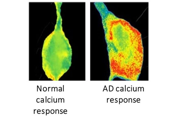 A New Tack to Stave Off Alzheimer's Years before the First Symptom