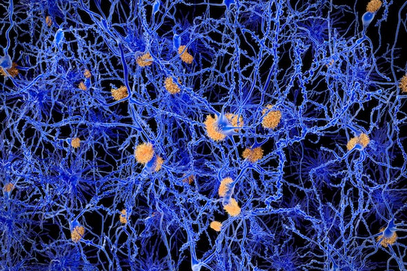 A New Idea about What Triggers Alzheimer's