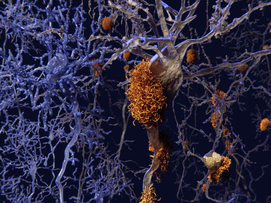 The Case for Transmissible Alzheimer's Grows - Scientific American Blog Network