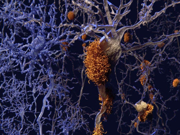 The Case for Transmissible Alzheimer's Grows