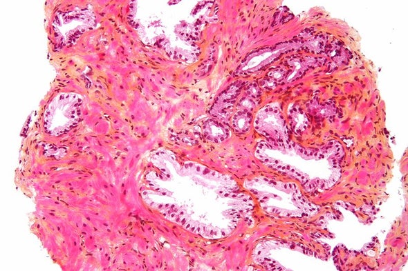 psa prostate cancer pdf