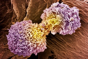 Can Lifelong, Invasive Screening Eradicate Cancer?