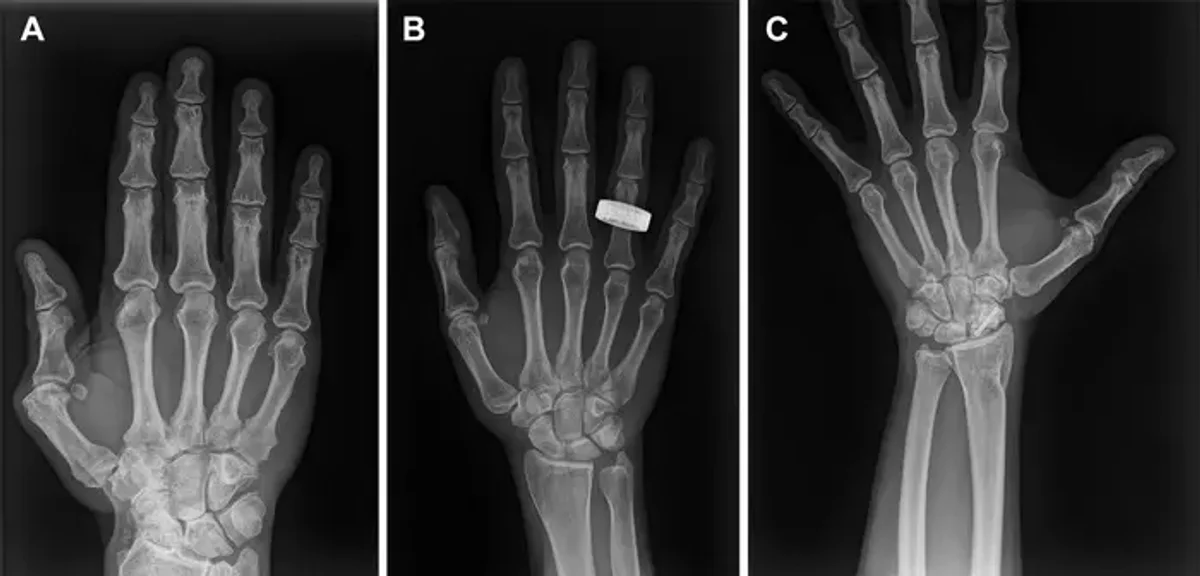 Three X-rays of a human hand