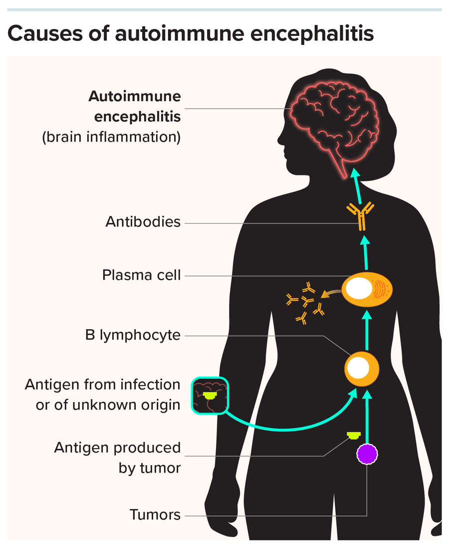 A figure of a woman is depicted, over whom is displayed steps of immune disruption that cause brain inflammation. A tumor, previous infection or unknown cause produces an antigen. That antigen elicits antibodies that cause brain inflammation.