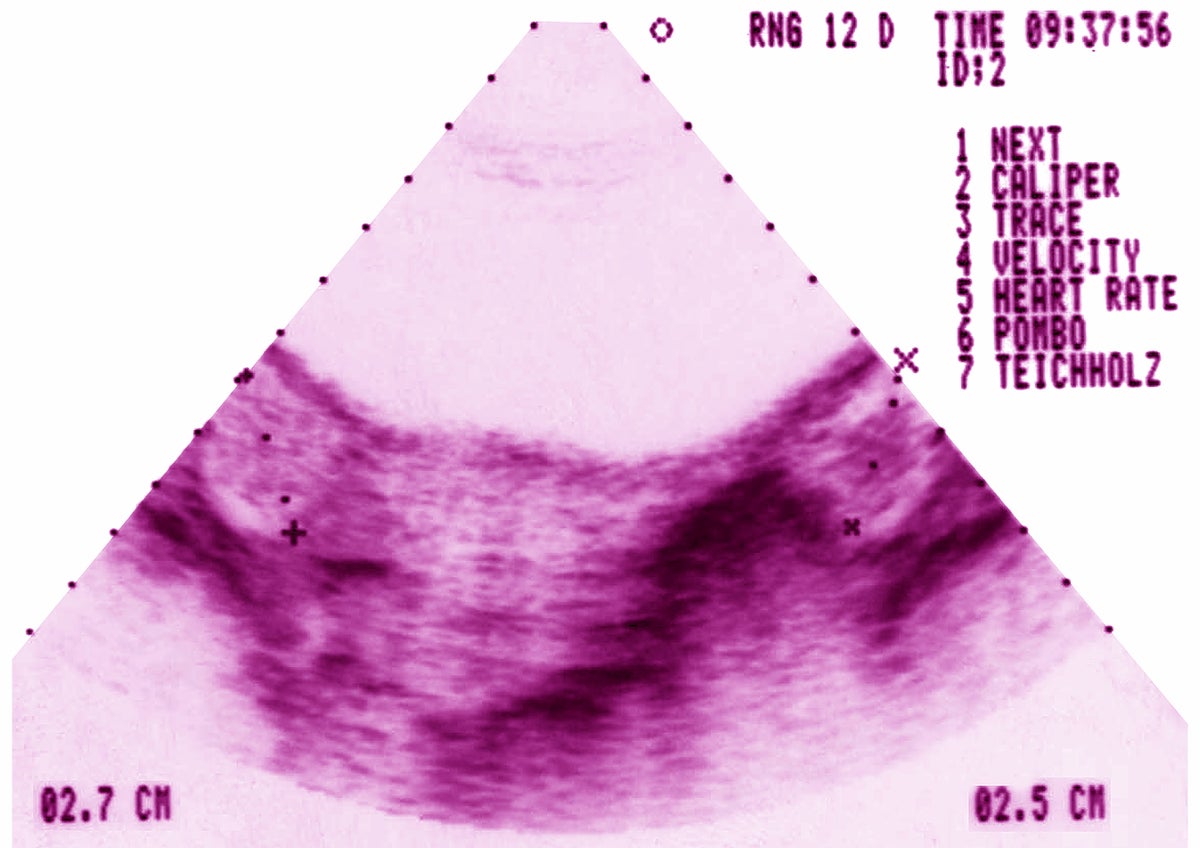 PCOS just got a new name—here’s what to know