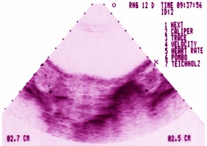 A gynecological ultrasound of ovarian dystrophy.