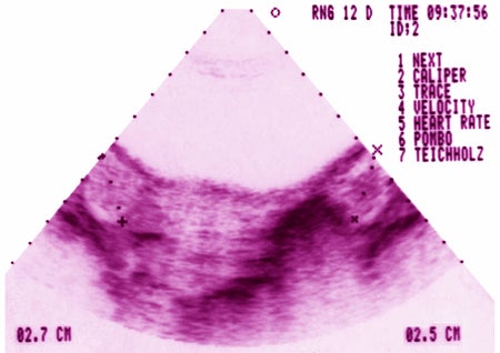 A gynecological ultrasound of ovarian dystrophy.