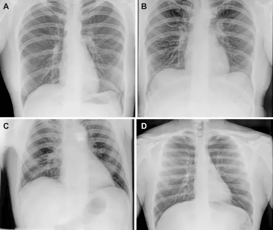 Four X-rays of a chest