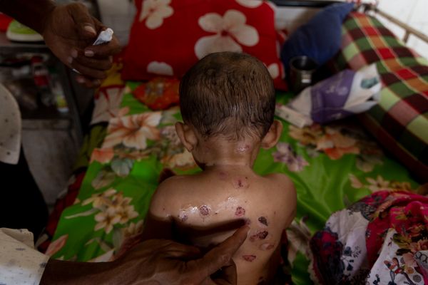 A child with measles is treated at the Infectious Diseases Hospital in Mohakhali on March 30, 2026 in Dhaka, Bangladesh