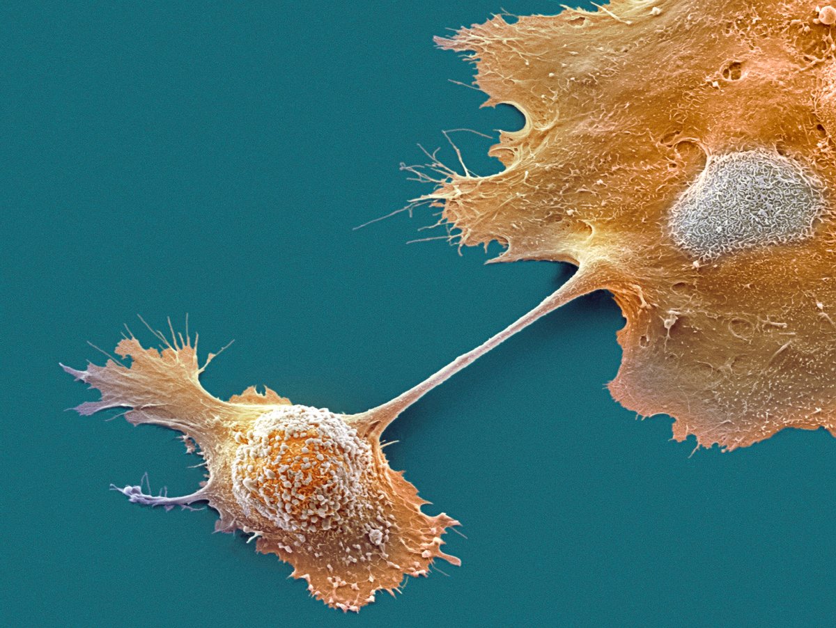 U.S. approves breakthrough pancreatic cancer drug, heralding a new era for an intractable disease