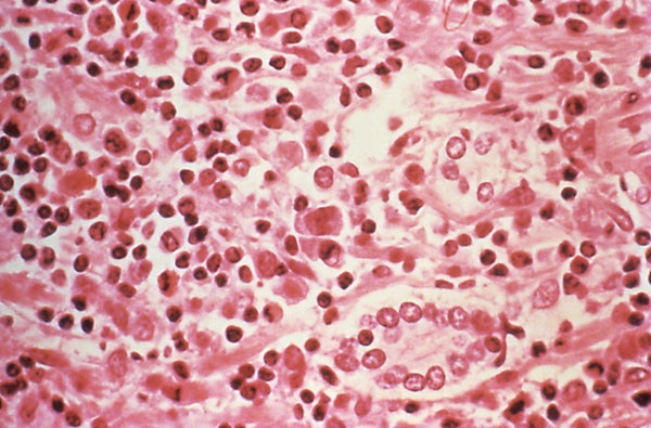 Liver tissue from a Hantavirus pulmonary syndrome patient.