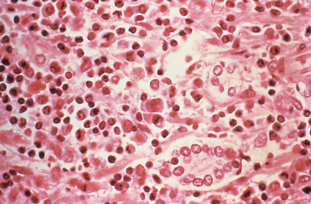 Liver tissue from a Hantavirus pulmonary syndrome patient.