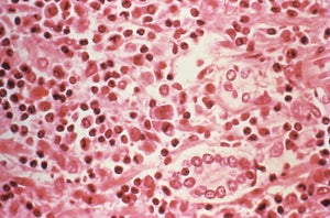 Liver tissue from a Hantavirus pulmonary syndrome patient.