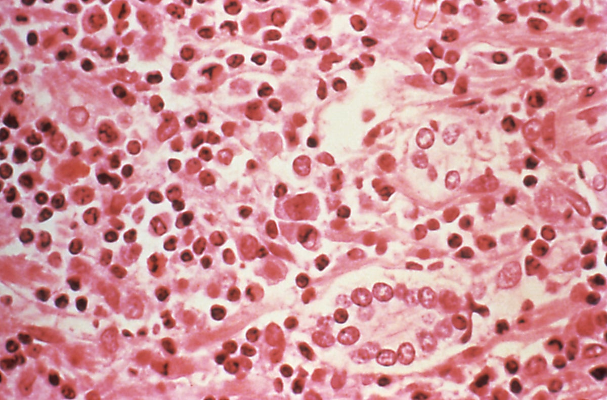Liver tissue from a Hantavirus pulmonary syndrome patient.