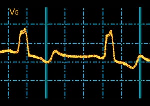 Electrocardiogram waveform on a dark grid, with sharp peaks tracing the heart’s electrical activity.