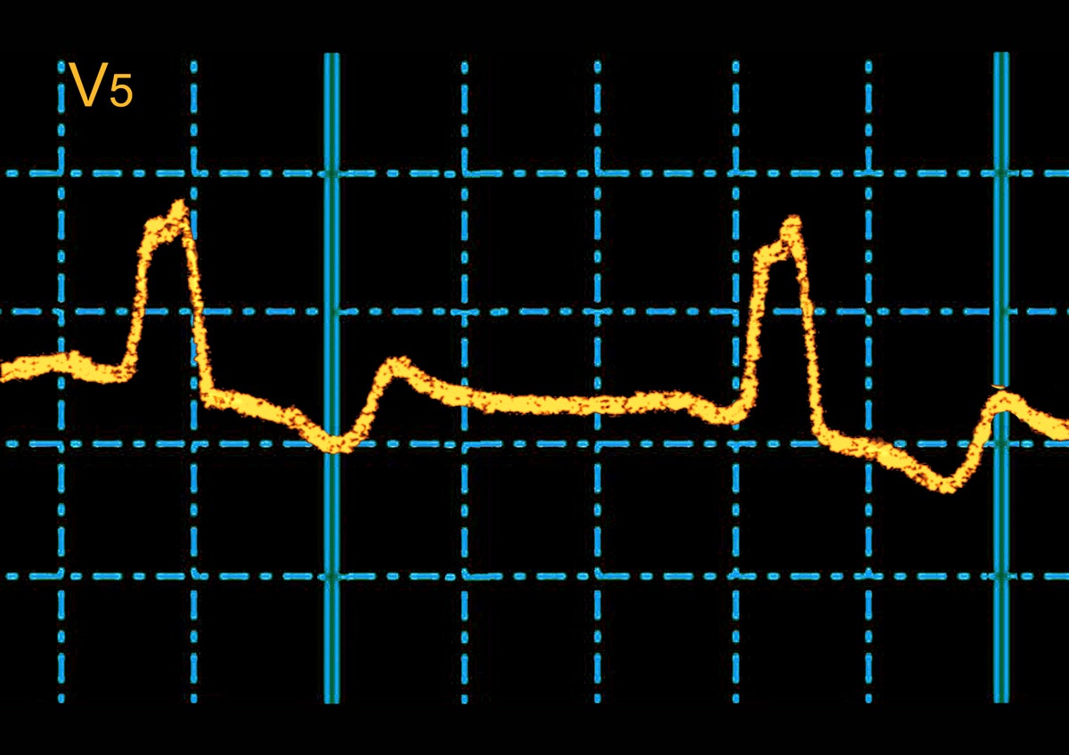 scientificamerican.com - Jacek Krywko - AI finds hidden ECG signal that predicts sudden cardiac death risk