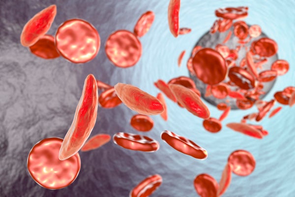 Illustration of normal and sickle-shaped red blood cells.