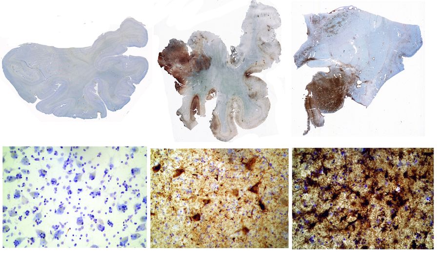 Three sections of brains showing no tau protein, abundant protein and severe protein buildup.