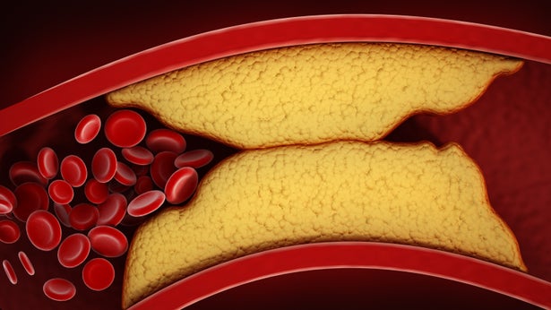 A three-dimensional visualization of thickened arteries and veins in coronary heart disease.