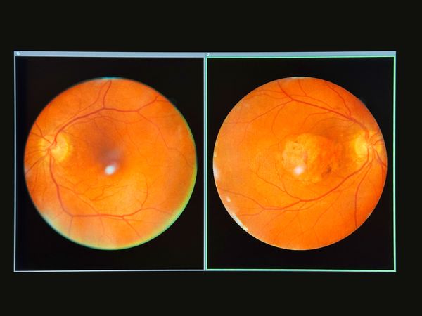 Retinal images showing a healthier eye on the left and an eye with macular damage on the right.