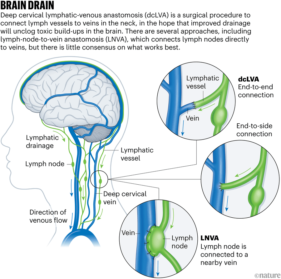 A process graphic shows how an Alzheimer’s surgery works: a gray brain drawing inside the outline of a head with three pull-out circles from the neck showing the parts of the lymphatic vessels that are being drained.