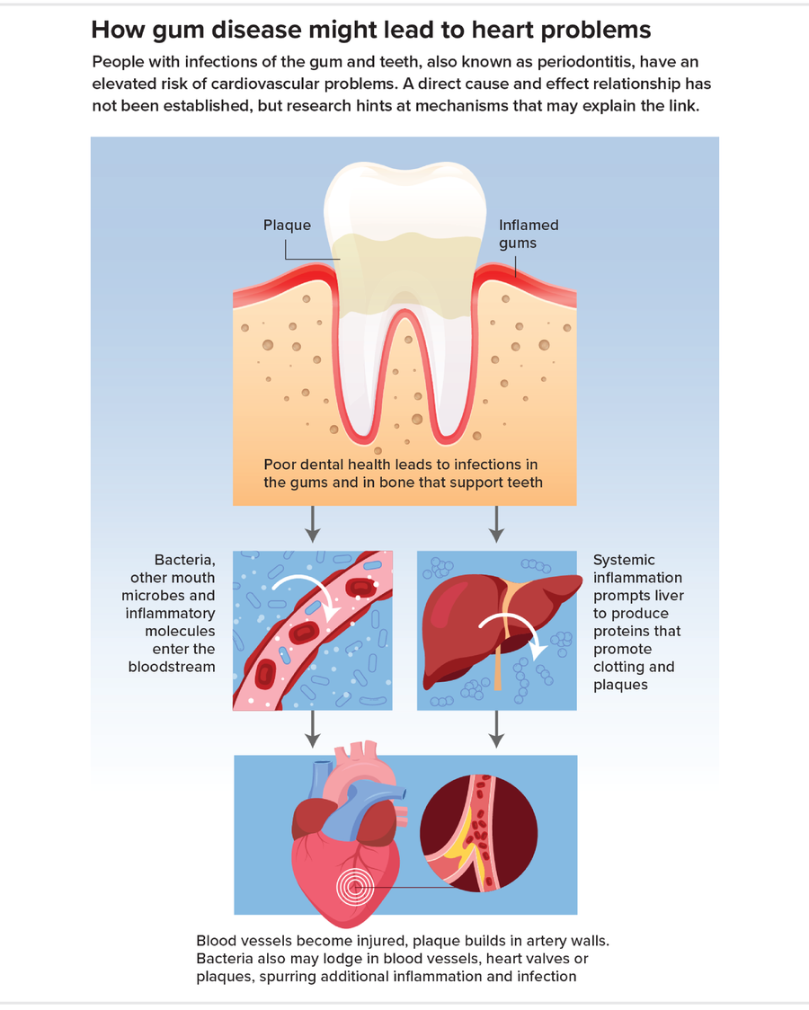 Graphic shows how chronic inflammation in the mouth, and oral bacteria, could lead to cardiovascular problems.