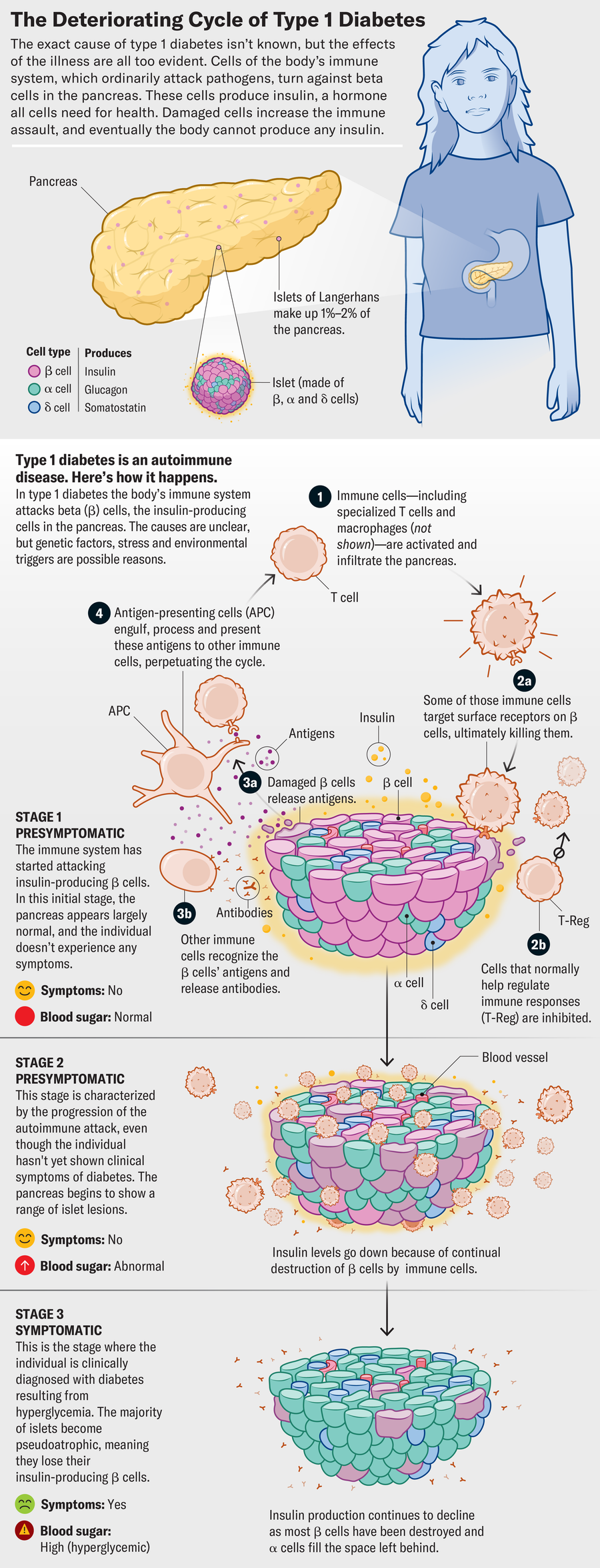 Graphic shows how type 1 diabetes progresses through three stages. Cells of the body’s immune system turn against beta cells in the pancreas. These cells produce insulin, a hormone all cells need for health. Damaged cells increase the immune assault, and eventually the body cannot produce any insulin