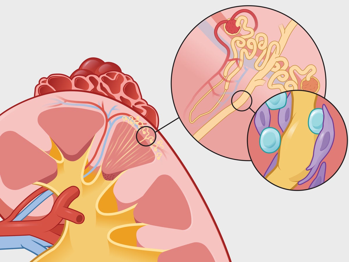 Why there is a distressing rise in kidney disease | Scientific American