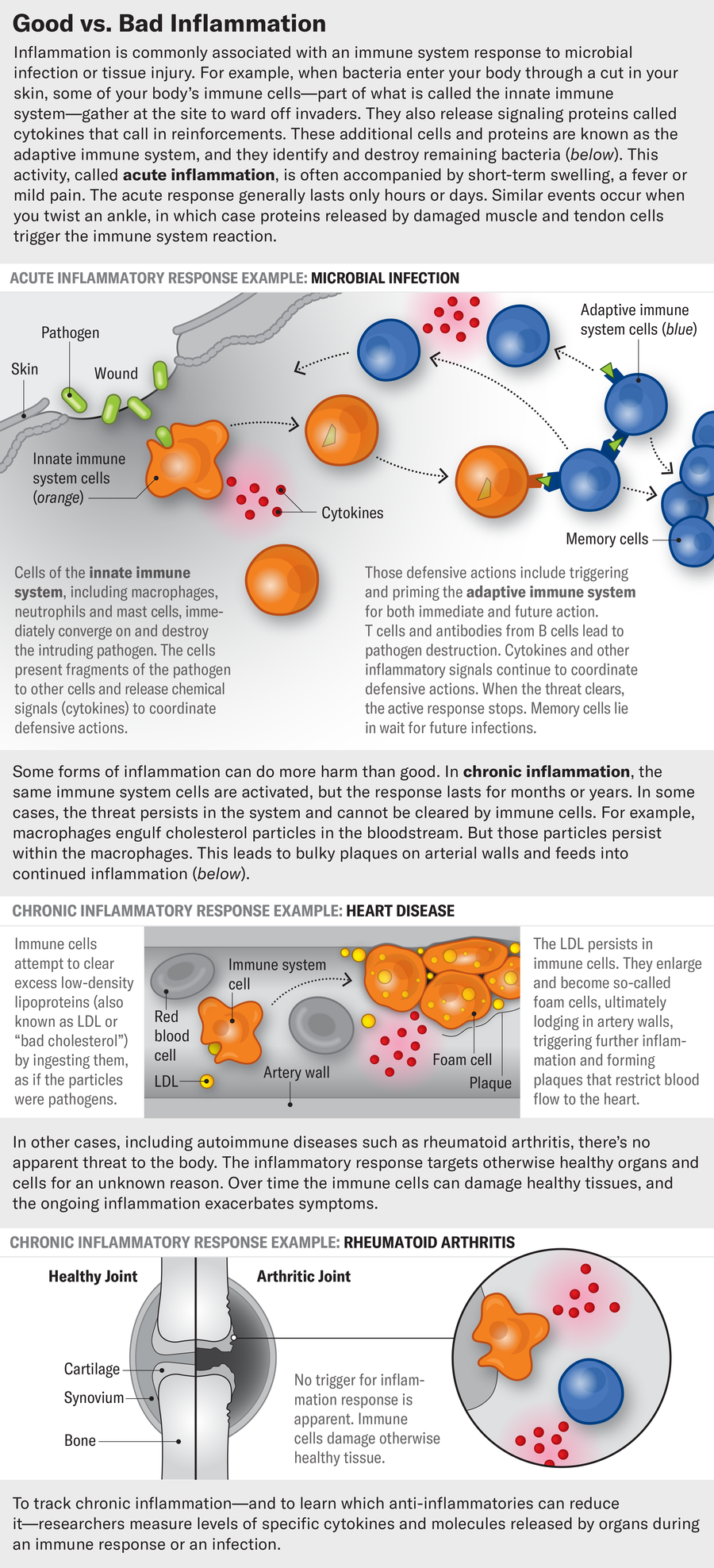 Graphic describes the similarities and differences between acute and chronic inflammation. Three examples are shown; an acute inflammatory response to a microbial infection, and chronic inflammation in the form of heart disease and rheumatoid arthritis.
