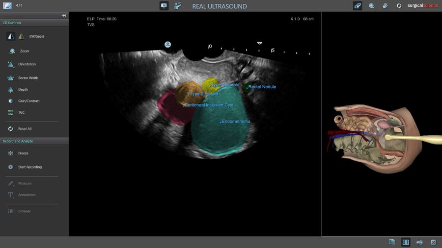 A screenshot of an image from Surgical Science's Ultrasound Mentor product showing uterine features and a graphical illustration of a female pelvis