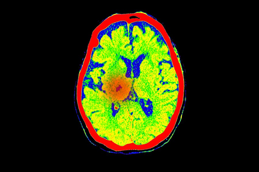 https://static.scientificamerican.com/dam/m/2c92076a9dcc60b4/original/CT_scan_of_brain_axial_showing_cerebral_blood_flow.jpg?w=900