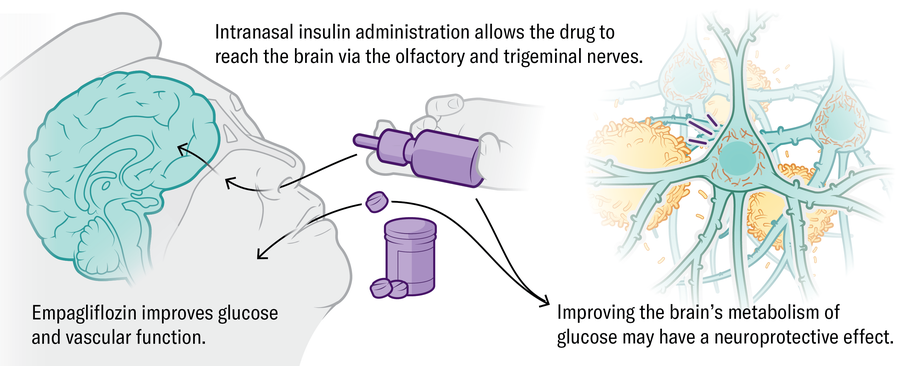 Ilustração mostra que a empolflozina de drogas pode melhorar o metabolismo da glicose do cérebro, provavelmente transmitindo um efeito neuroprotetor