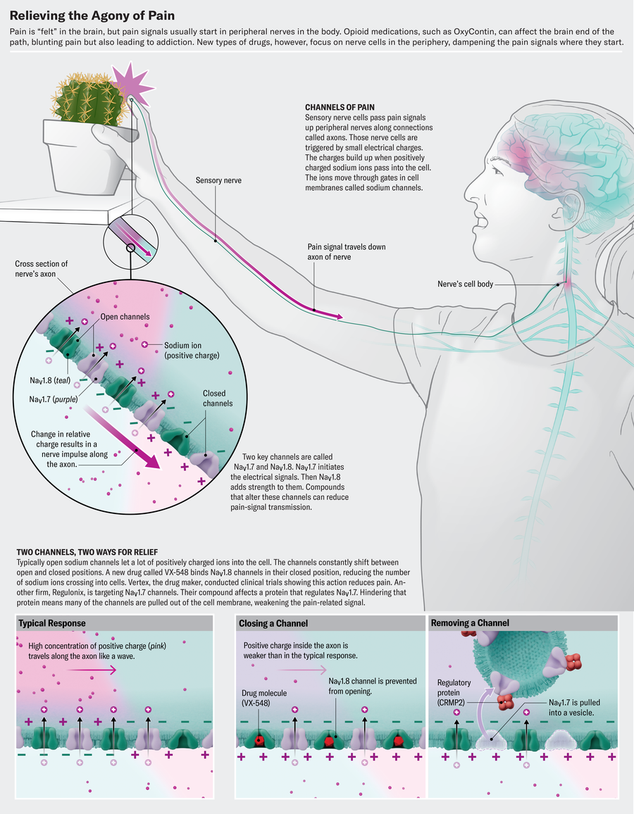 New Pain Medication Suzetrigine Prevents Pain Signals from Reaching Brain