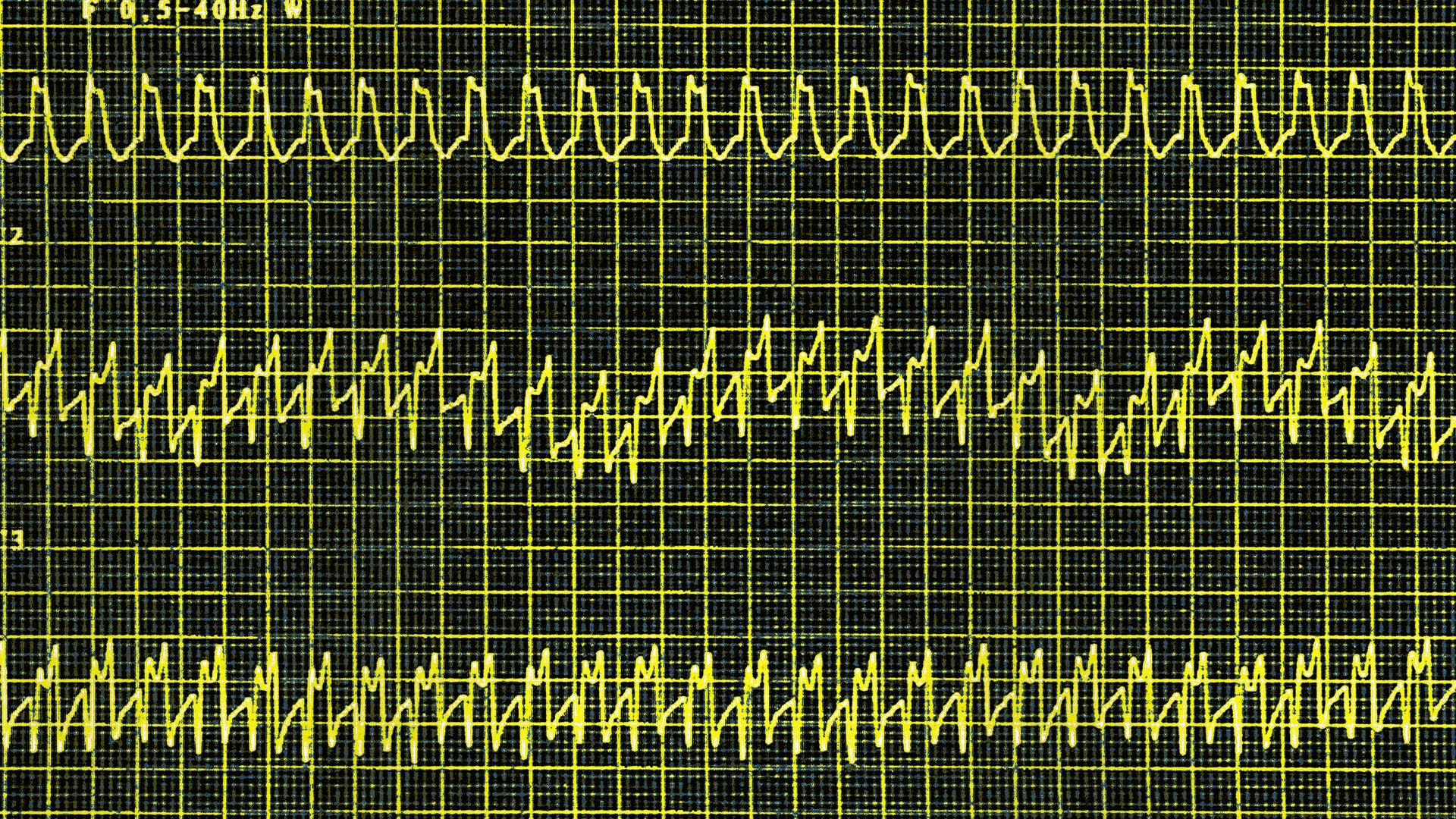 heart palpitations semaglutide Wegovy Is First Weight-Loss Drug Approved for Heart Diseases