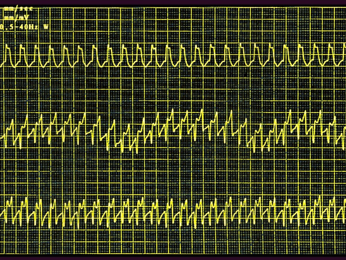 semaglutide heart palpitations Wegovy Is First Weight-Loss Drug Approved for Heart Diseases