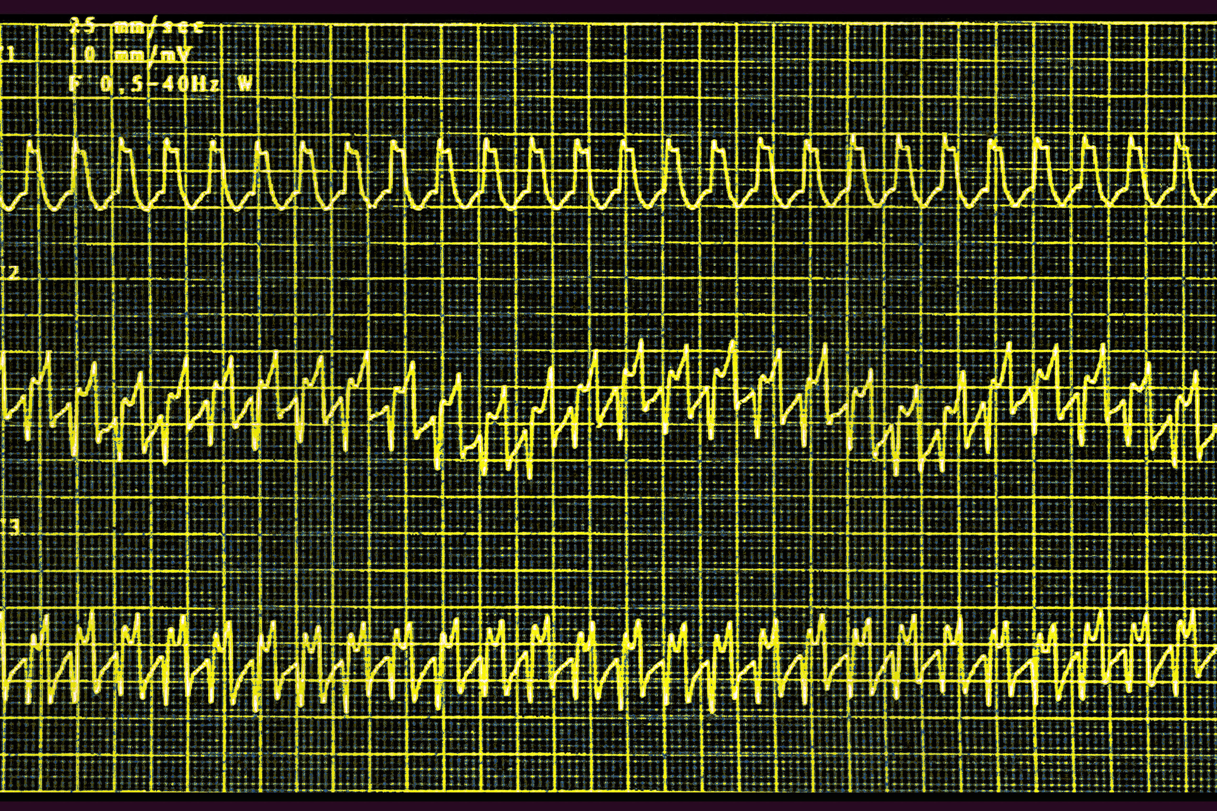 tachycardia semaglutide Wegovy Is First Weight-Loss Drug Approved for Heart Diseases