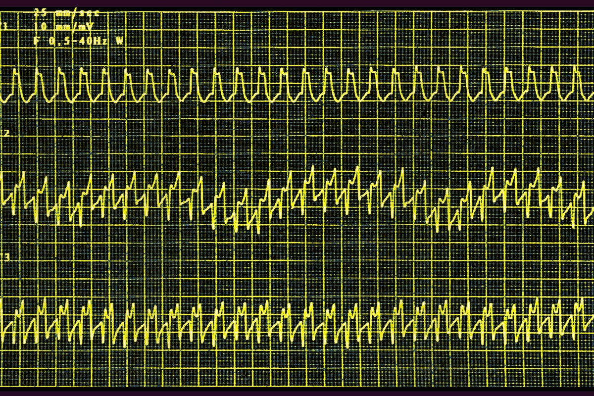 does semaglutide cause tachycardia Wegovy Is First Weight-Loss Drug Approved for Heart Diseases