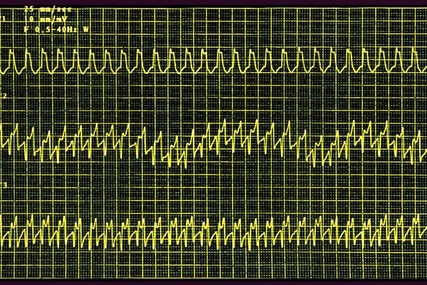 EKG screen display